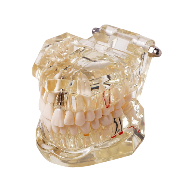Dental Model For Patient Education